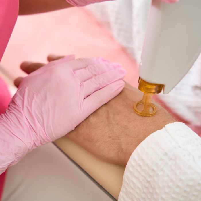 Laser hair removal on male arm in beauty salon. Close up photo